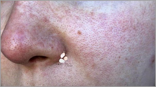 10 Domowych Sposobów na Cerę Naczynkową!