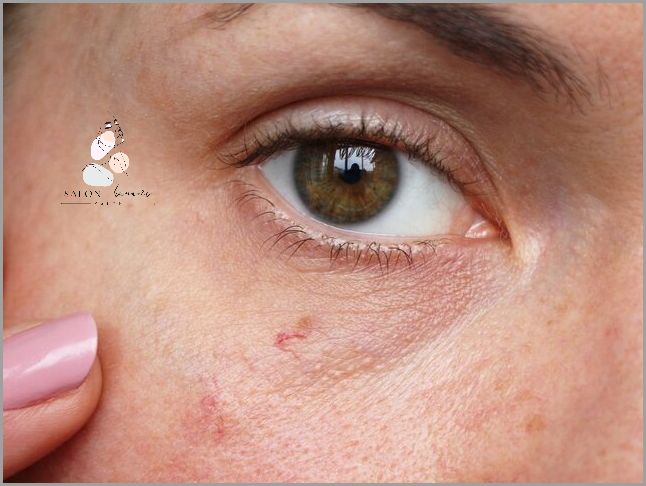 10 Domowych Sposobów na Cerę Naczynkową!