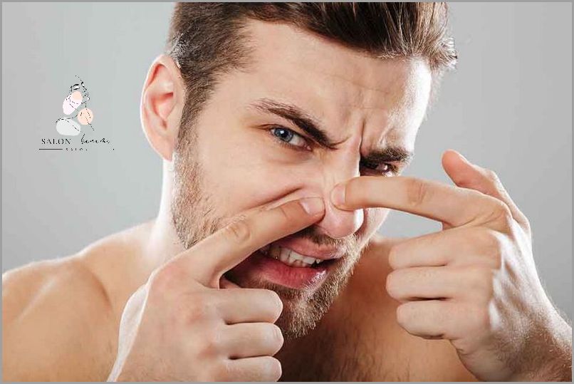 10 Domowych Sposobów Na Pryszcze I Wągry!