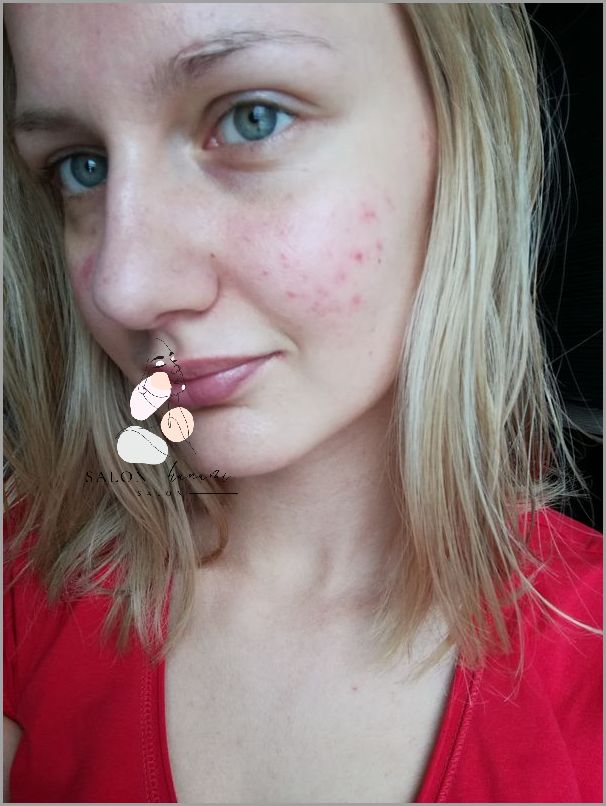 5 Maści Na Przebarwienia Po Trądziku!