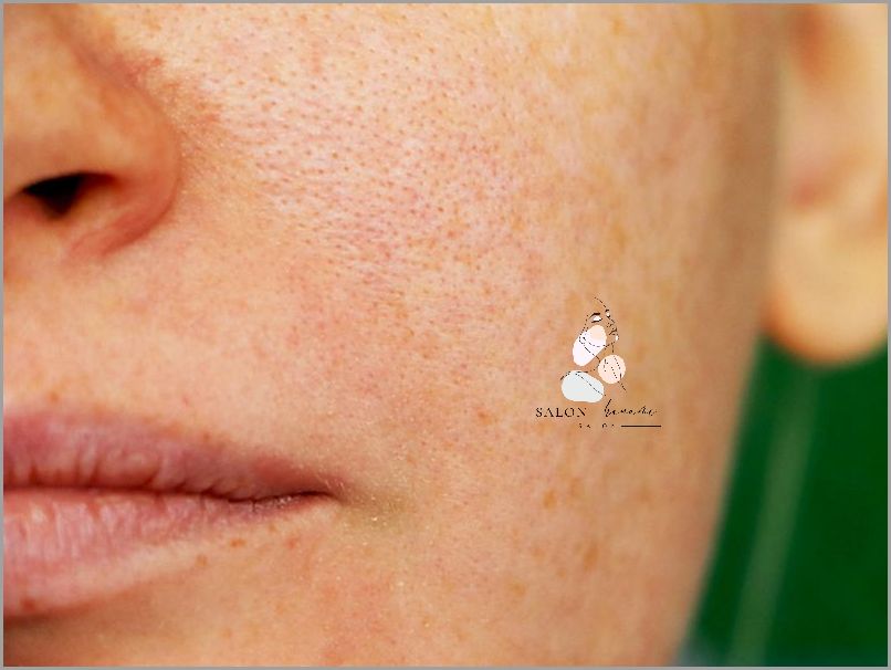 Co Zdziałać Krem Na Przebarwienia Na Twarzy?