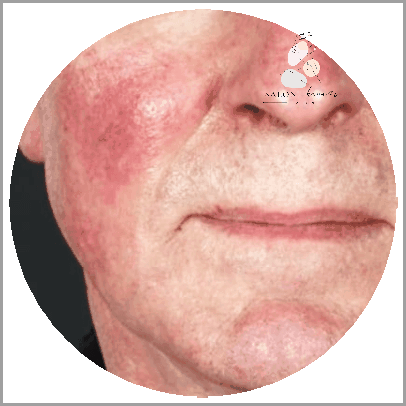 Czerwona Twarz U Mężczyzn - Co Oznacza?