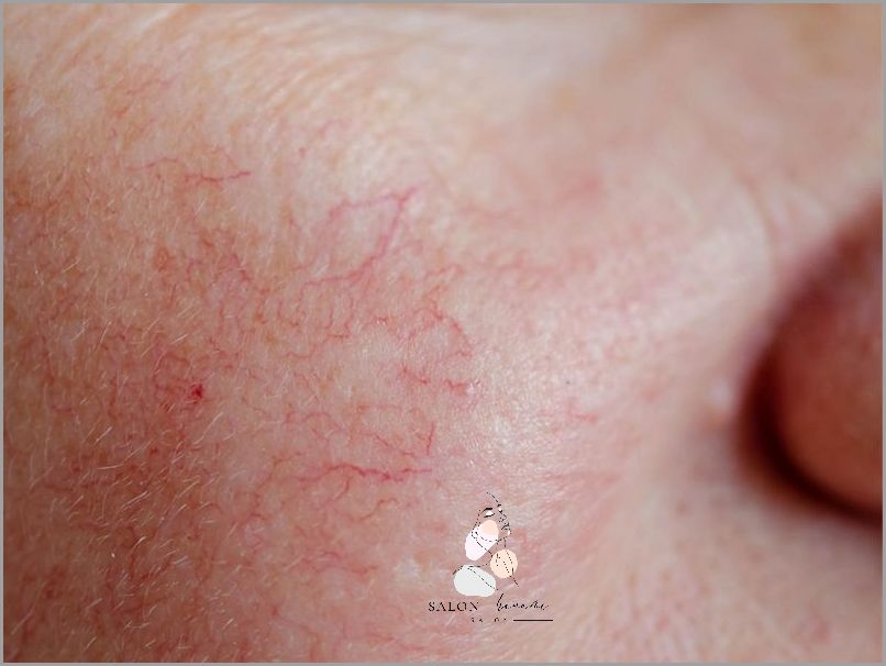 Czerwona Twarz U Mężczyzn - Co Oznacza?