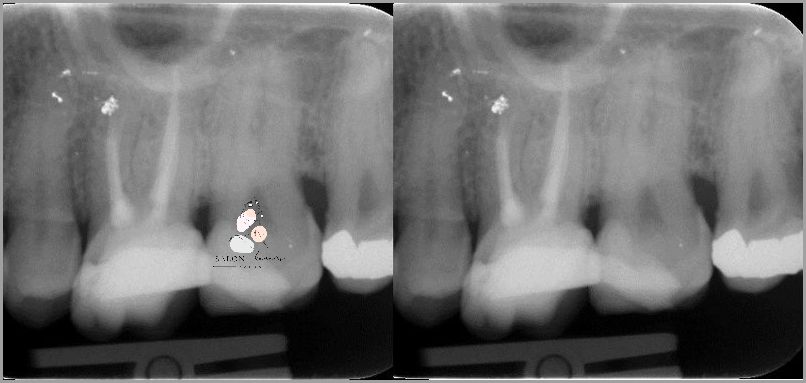 Czy Ból Zęba Po Leczeniu Kanałowym to Norma? - Forum.