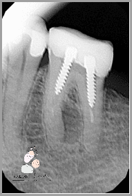 Czy Ból Zęba Po Leczeniu Kanałowym to Norma? - Forum.