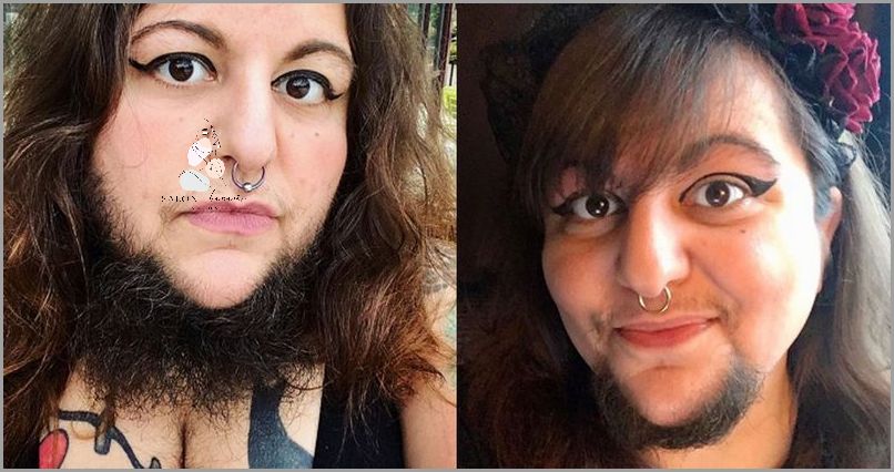 Czy Nadmierne Owłosienie Może Zniknąć?