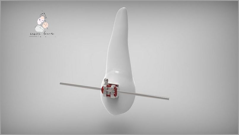 Czy Zakładanie Aparatu Boli? Sprawdź!