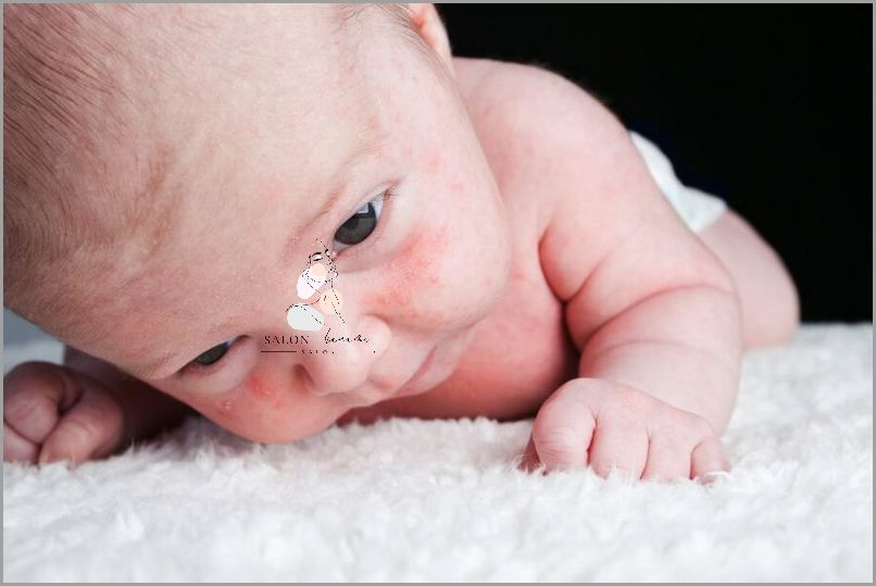 Czym Smarować Trądzik Niemowlęcy? Odkryj!