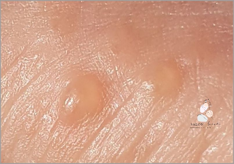 Efekt W Czasie Kilku Dni - Maść Na Plamy Na Skórze!