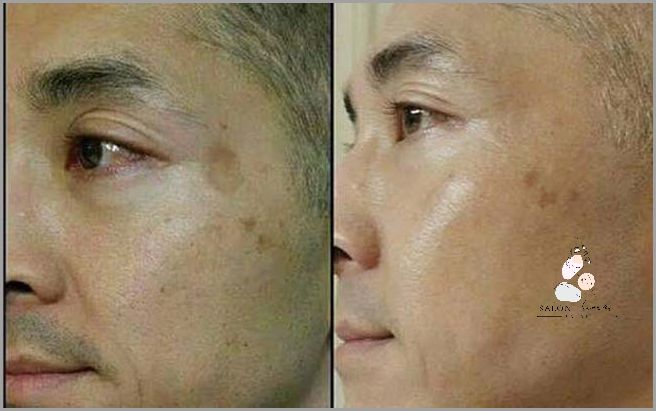 Efekt W Czasie Kilku Dni - Maść Na Plamy Na Skórze!