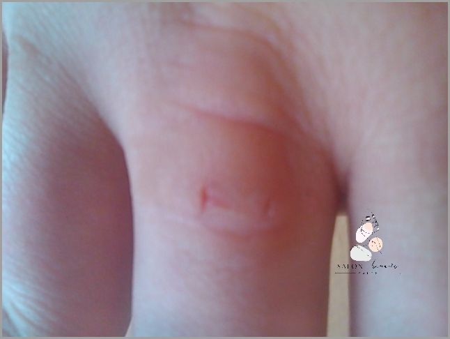 Efekt W Czasie Kilku Dni - Maść Na Plamy Na Skórze!