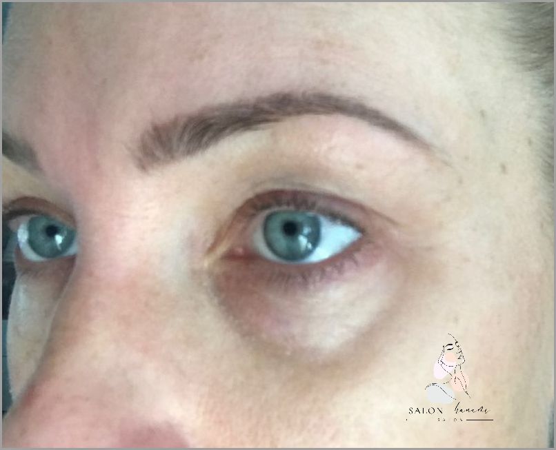 Efekty Stosowania Kwasu Hialuronowego Pod Oczy!