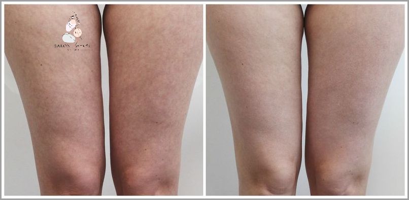 Endermologia: Widoczne Efekty Po 6 Zabiegach!