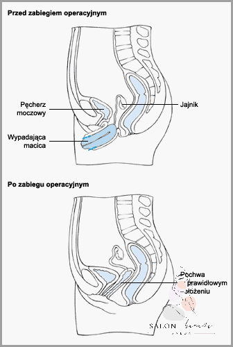Forum: Jak Skracać Szyjkę Macicy?