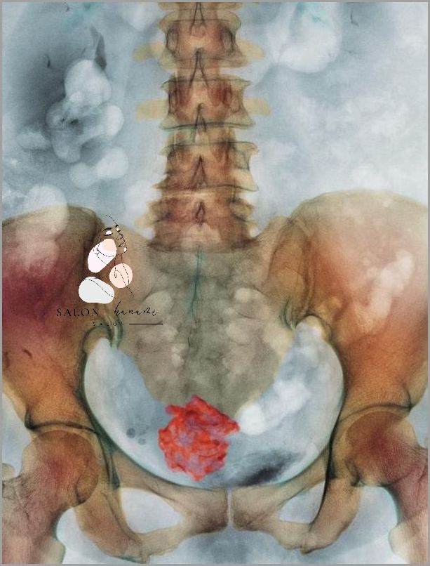 Forum Mięśniaków Macicy: Tajemnice Lekarzy!