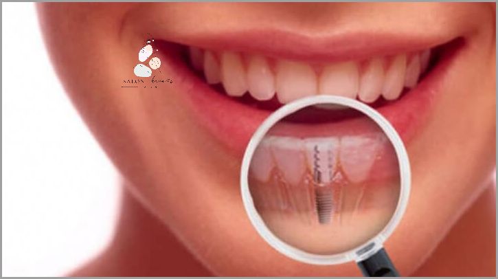 Ile Kosztują Implanty Zębowe? Forum Dowie Się!