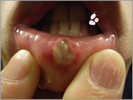 Ile Trwa Opryszczka Na Ustach? Odpowiadamy!