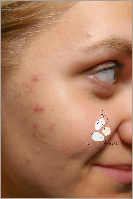 Jak Poradzić Sobie z Trądzikiem Hormonalnym Na Plecach?