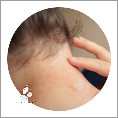 Jak Poradzić Sobie z Trądzikiem Hormonalnym Na Plecach?