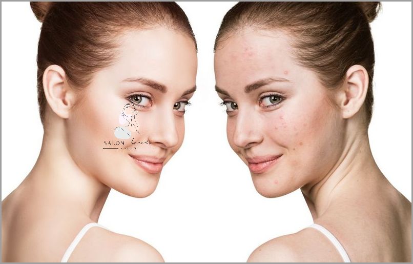 Jak Poradzić Sobie z Trądzikiem Hormonalnym Na Plecach?