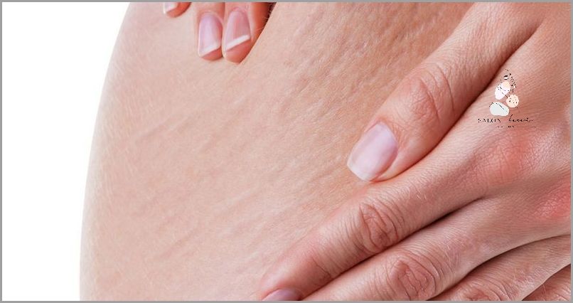 Jak Pozbyć Się Cellulitu Z Ud? Sprawdź!