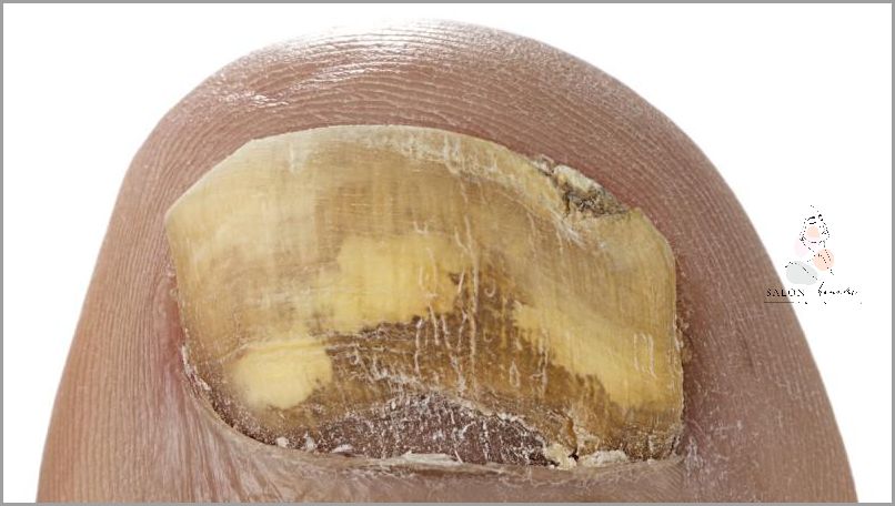 Jak Pozbyć Się Żółtych Przebarwień Na Paznokciach?