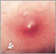 Jak Pozbyć Się Pryszczy Na Brodzie Od Maseczki?