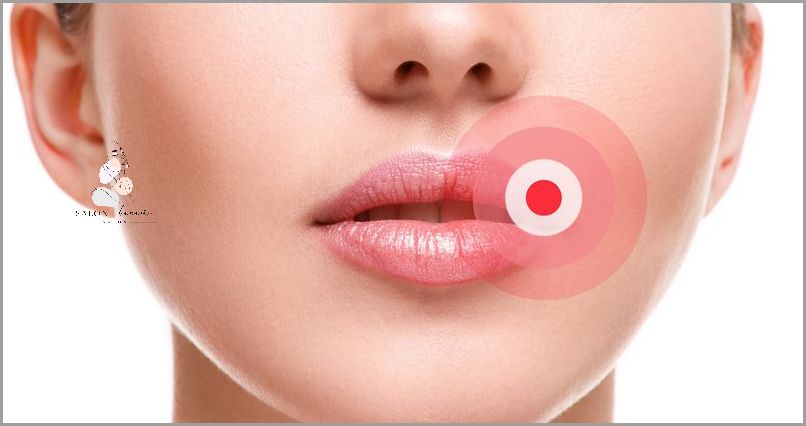 Jak Skutecznie Leczyć Opryszczkę Na Ustach?