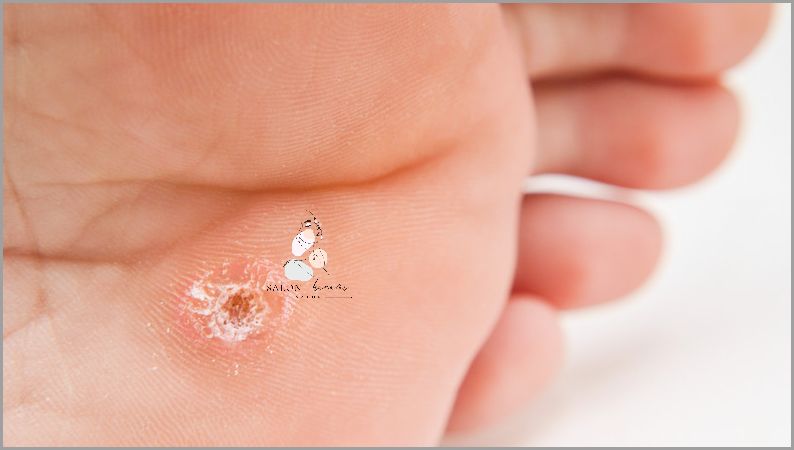 Jak Skutecznie Pozbyć Się Brodawczaka?