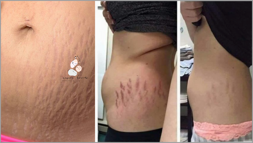 Jak Skutecznie Pozbyć Się Brzucha Po 40?