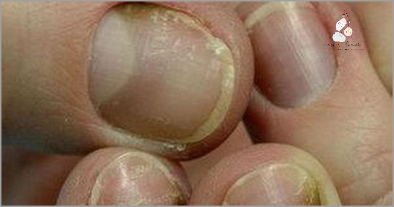 Jak Skutecznie Wytępić Pseudomonas Aeruginosa? Jak Skutecznie Wytępić Pseudomonas Aeruginosa?