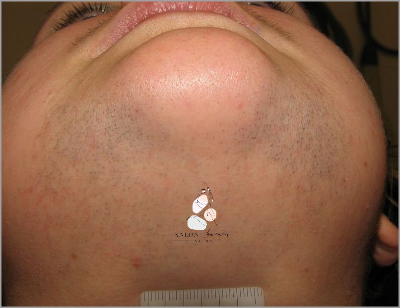 Jak Uniknąć Oparzeń Po Depilacji Laserowej? Jak Uniknąć Oparzeń Po Depilacji Laserowej?