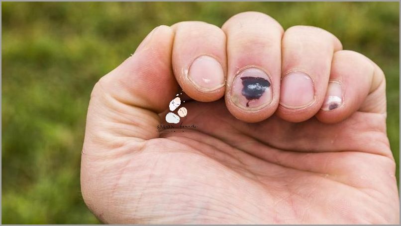 Jak Uniknąć Raka Paznokcia Po Hybrydzie?