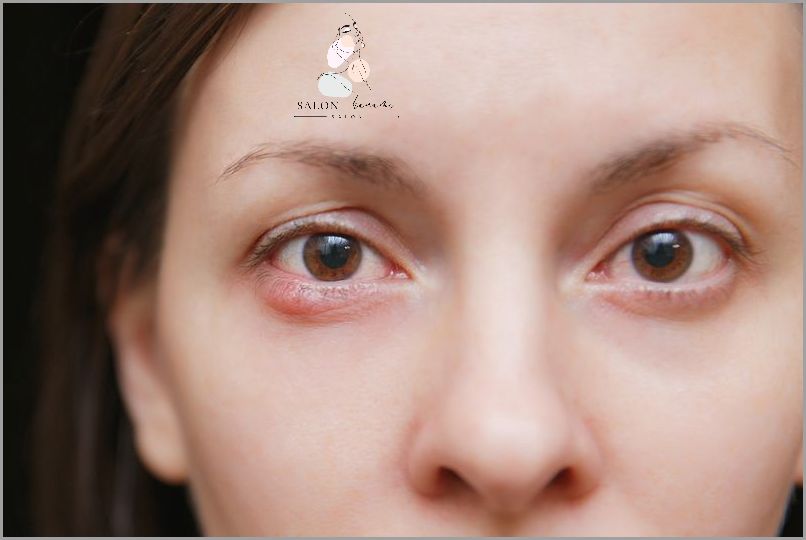 Jęczmień Na Oku: Przyczyny Ujawnione! Jęczmień Na Oku: Przyczyny Ujawnione!