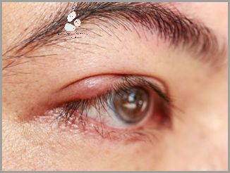 Jęczmień Na Oku: Przyczyny Ujawnione! Jęczmień Na Oku: Przyczyny Ujawnione!