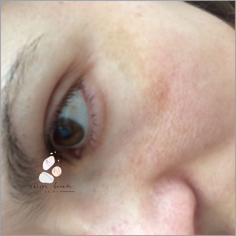 Krem Na Chomiki Na Twarzy: Czy jest skuteczny? Krem Na Chomiki Na Twarzy: Czy jest skuteczny?