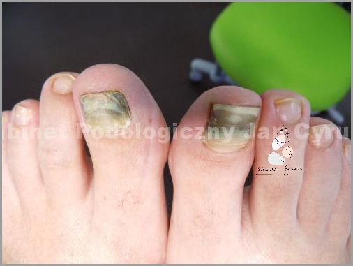 Krwiak Na Udzie - Niepokojące Objawy!