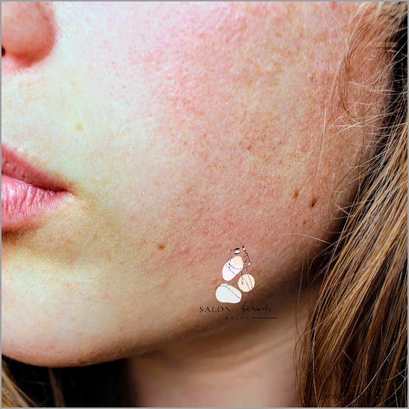 Kwas Migdałowy - Skuteczny Na Trądzik!