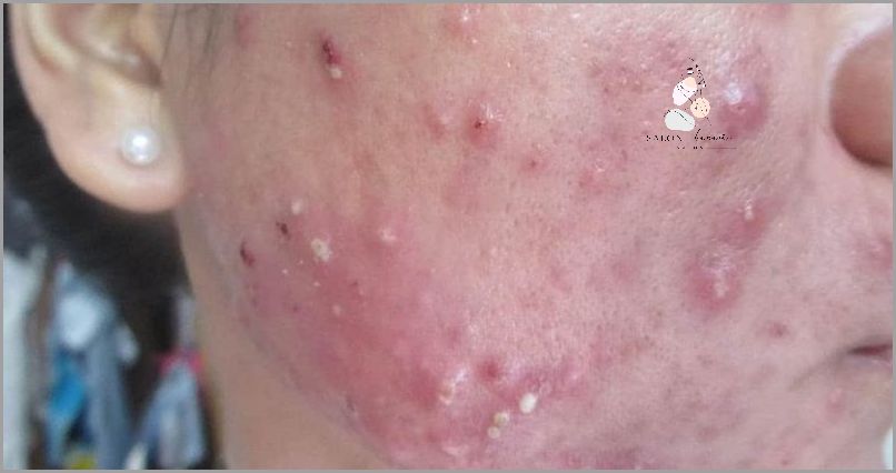 Lekarz Odkrywa: Ropne Pryszcze Po Alkoholu!