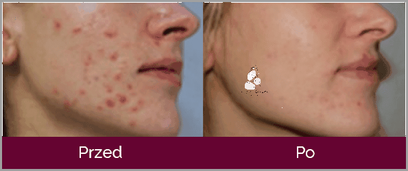 Lekarz Odkrywa: Ropne Pryszcze Po Alkoholu!