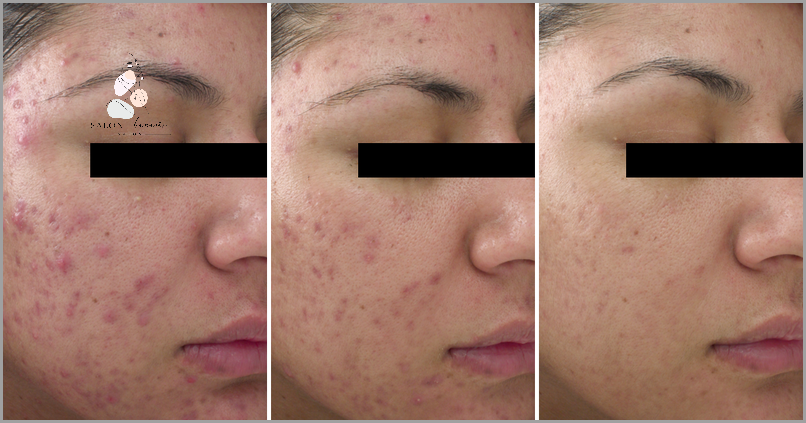 Lekarz Odkrywa: Ropne Pryszcze Po Alkoholu!