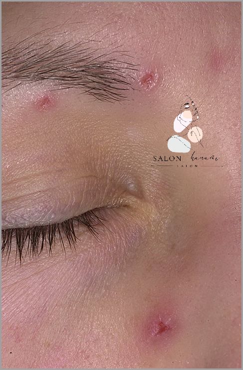 Lekarz Ostrzega: Trądzik Po Jednej Stronie Twarzy!