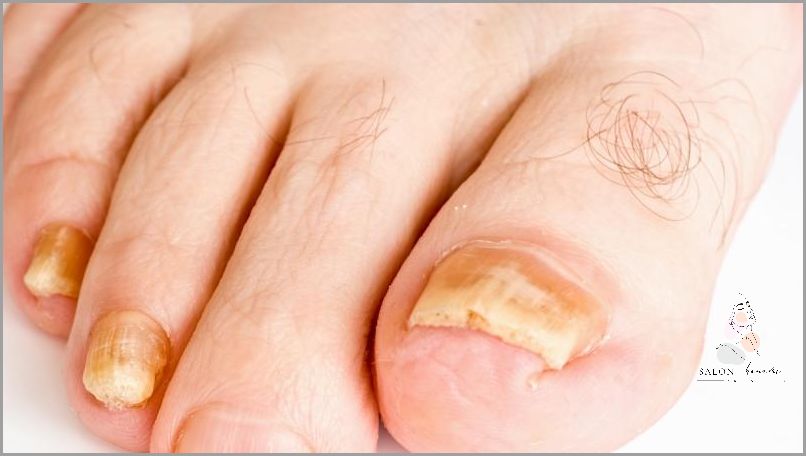 Lekarz ostrzega: Zaawansowana Grzybica Paznokci U Nóg!