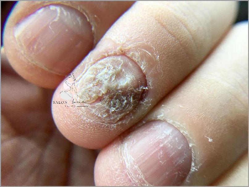 Lekarz ostrzega: Zaawansowana Grzybica Paznokci U Nóg!