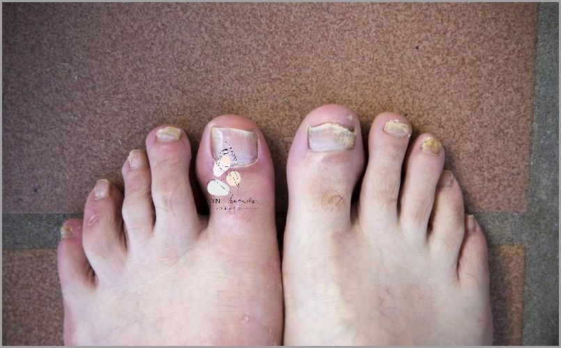 Lekarz ostrzega: Zaawansowana Grzybica Paznokci U Nóg!