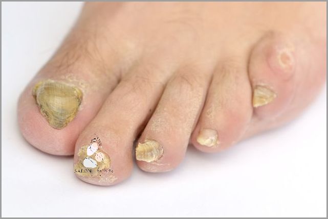 Lekarz ostrzega: Zaawansowana Grzybica Paznokci U Nóg!