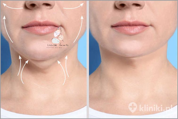 Lipoliza Iniekcyjna: Efekty Zdjęć - Zaskakujące!