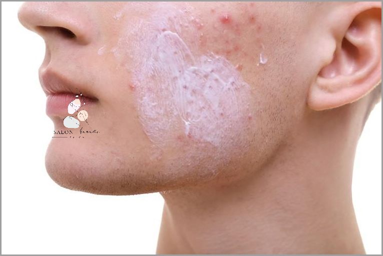 Maseczka Z Sody - Skuteczny Sposób Na Wągry!