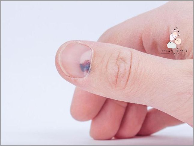 Nie Rosną Paznokcie? Znajdź Przyczyny!