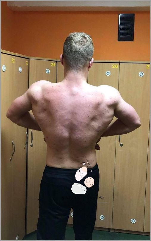 Niesamowite Efekty Bez Wyciskania Pryszczy!